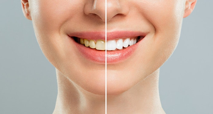 Enjoy the Benefits Of Teeth Whitening In North Olmsted